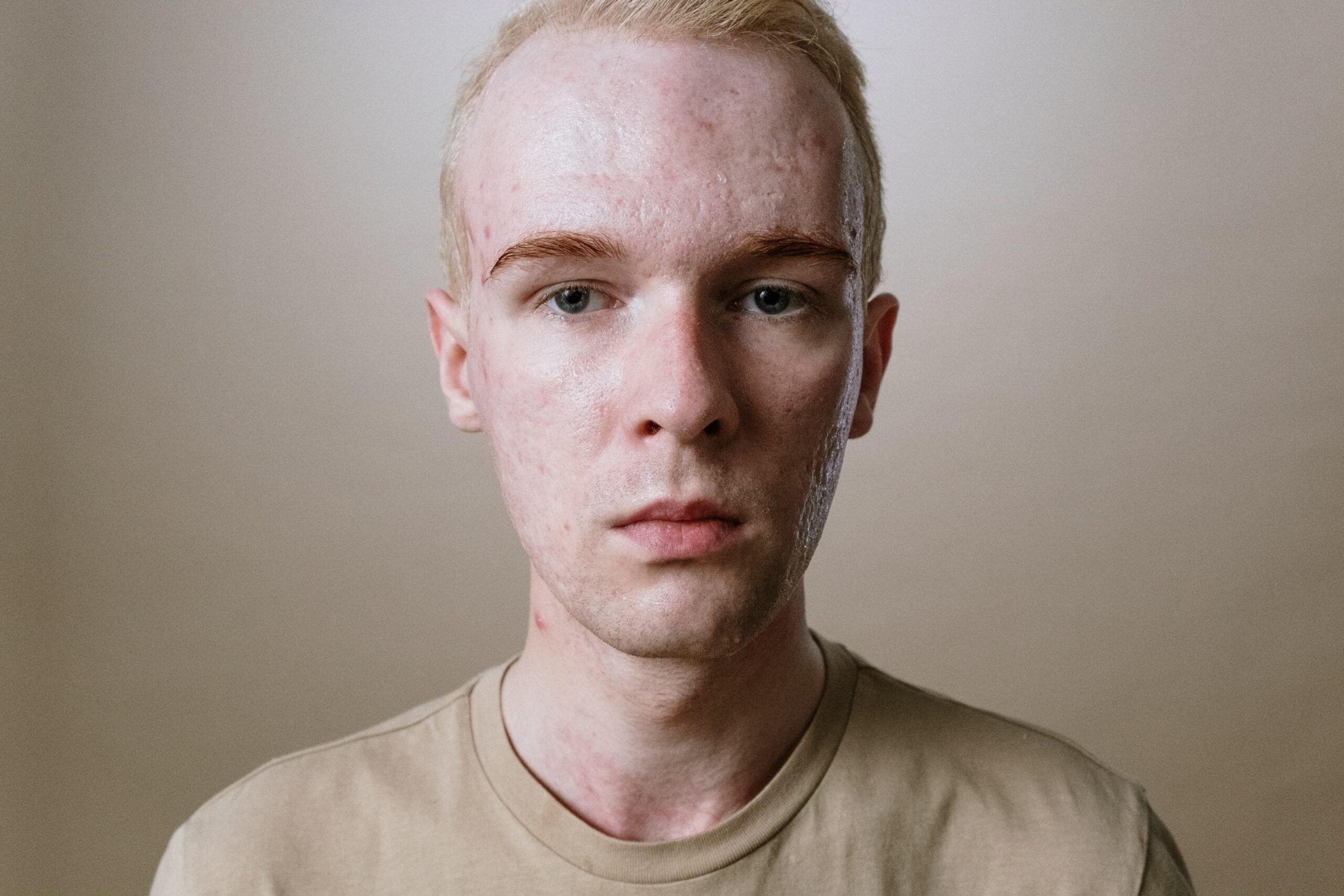 Acne oily skin white male